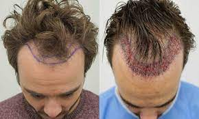 How Much Is Hair Transplant In south Africa - 2023 | ZaR